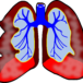Zapalenie płuc wciąż groźna choroba